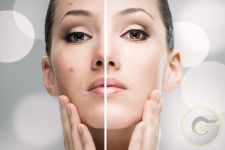Acne Facial skin care hollywood